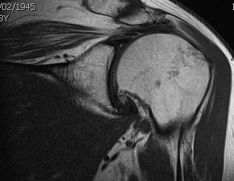 Shoulder MRI Supraspinatous Fatty Infiltration